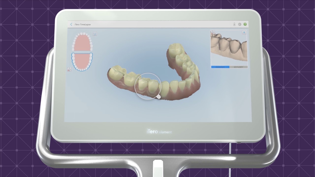 iTero Element: Your Intuitive Digital Solution